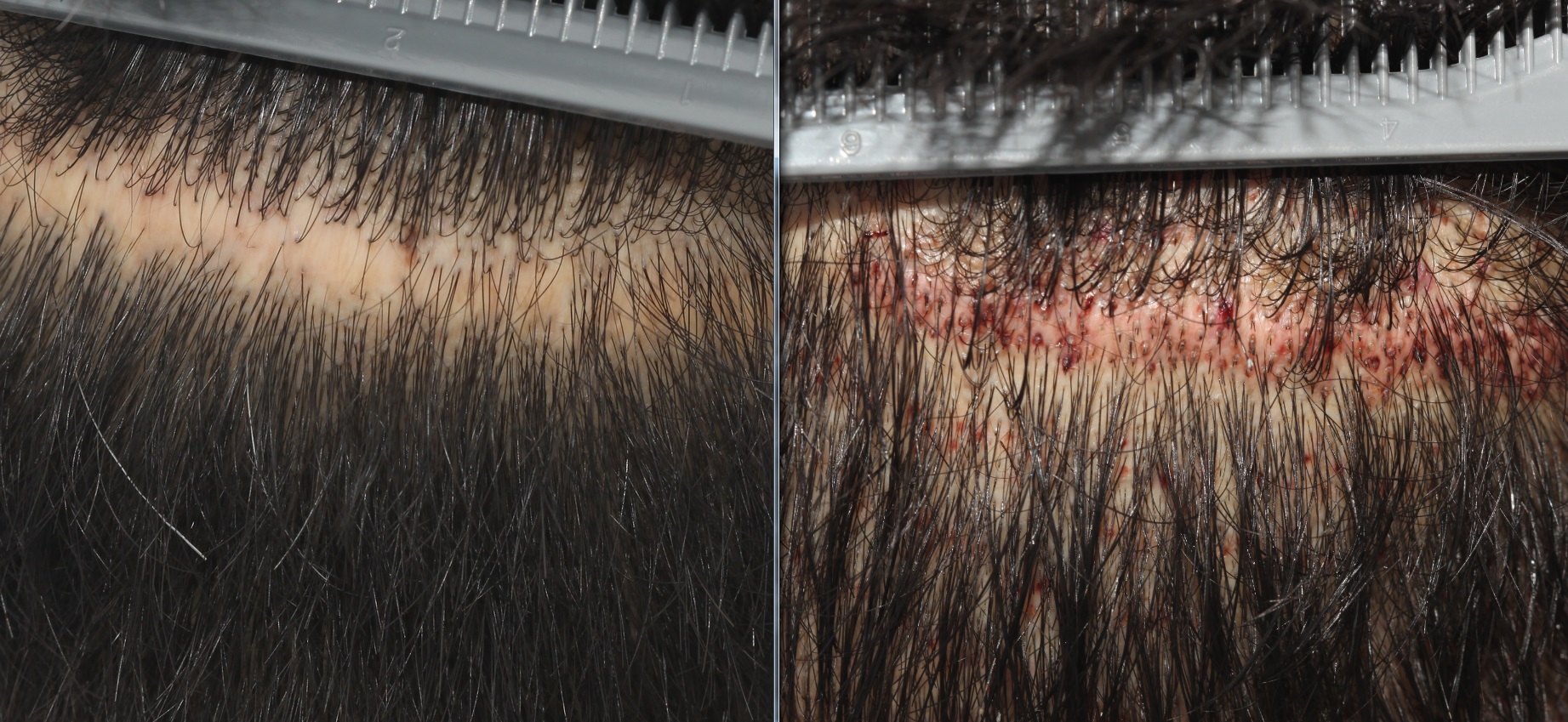 FUE hair transplant in scar